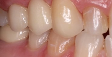Replacing a Tooth With a Bridge - After