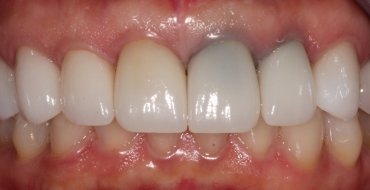 Improving Tooth Color By Replacing Old, Dark Crowns - Before