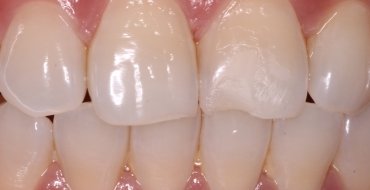 Restoring a Front Tooth With Simple Bonding - Before
