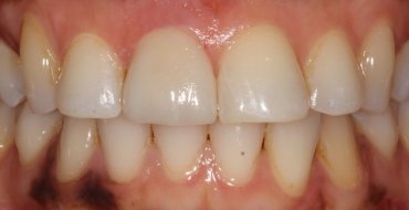 Improving Tooth Color With a Crown - After