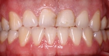Improving Appearance and Strength With Crowns - Before