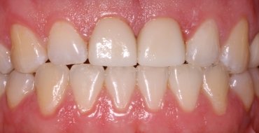 Improving Appearance and Strength With Crowns - After