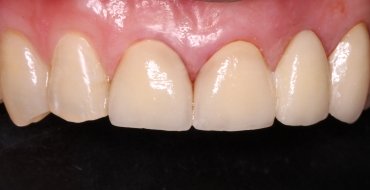 Improving Appearance and Health By Removing Infected Tooth and Placing Bridge - After