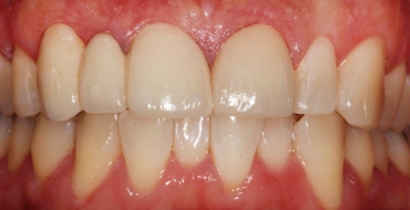 Improving Color and Size By Replacing Old Bridge and Doing a Veneer - After