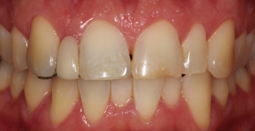 Improving Color and Size By Replacing Old Bridge and Doing a Veneer - Before