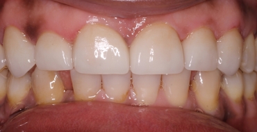 Closing Large Spaces With Crowns - After