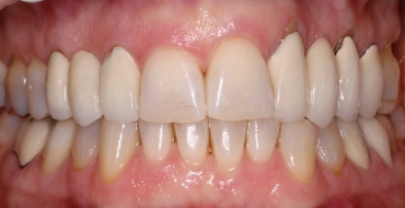 Invisalign 1.5 Year Case - After