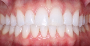 Invisalign 5 Month Case - After