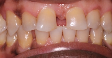 Closing Large Spaces With Crowns - Before