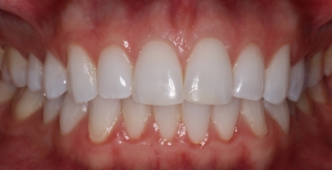 Invisalign 5 Month Case - Before
