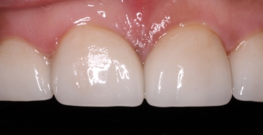 Closing Large Spaces With Crowns - After