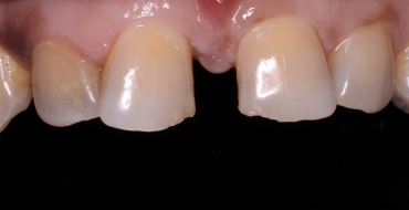 Closing Large Spaces With Crowns - Before