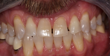 Simple Bonding to Close Spaces - Before