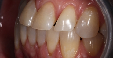 Simple Bonding to Close Spaces - Before