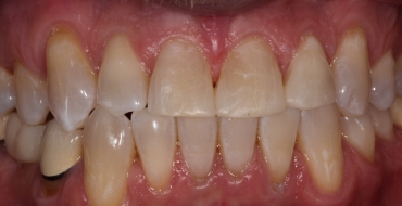 Simple Bonding to Close Spaces - After