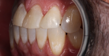 Simple Bonding to Close Spaces - After