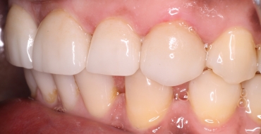 Closing Large Spaces With Crowns - After