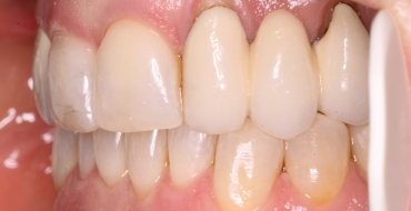 Invisalign 1.5 Year Case - After