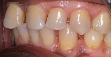 Closing Large Spaces With Crowns - Before