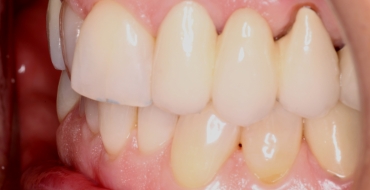 Invisalign 1.5 Year Case - Before