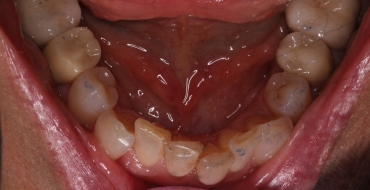 Invisalign 1.5 Year Case - Before