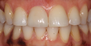Improving Tooth Color With a Crown - After