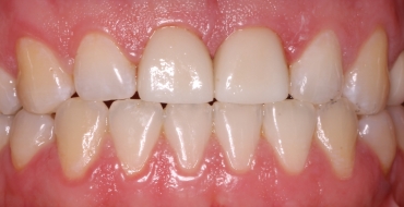 Improving Appearance and Strength With Crowns - After