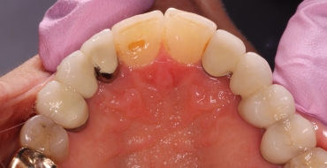Invisalign 1.5 Year Case - After