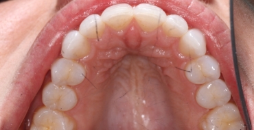Invisalign 5 Month Case - After