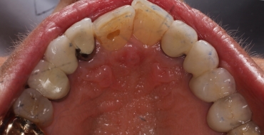 Invisalign 1.5 Year Case - Before