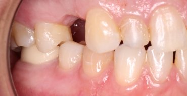 Replacing a Tooth With a Bridge - Before
