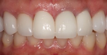 Improving Tooth Color By Replacing Old, Dark Crowns - After
