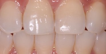 Restoring a Front Tooth With Simple Bonding - After