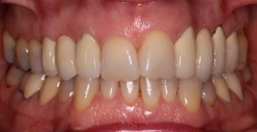 Invisalign 1.5 Year Case - Before