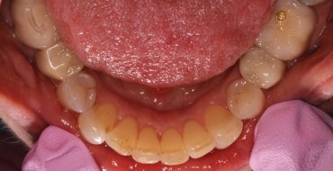 Invisalign 1.5 Year Case - After