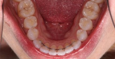 Invisalign 5 Month Case - After
