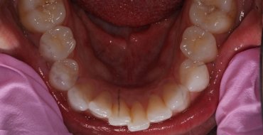 Invisalign 5 Month Case - Before