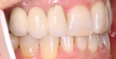 Invisalign 1.5 Year Case - After