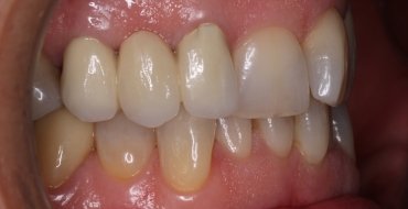 Invisalign 1.5 Year Case - Before