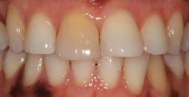 Improving Tooth Color With a Crown - Before