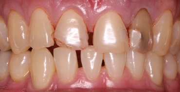 Improving Appearance and Health By Removing Infected Tooth and Placing Bridge - Before
