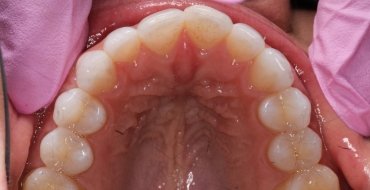 Invisalign 5 Month Case - Before